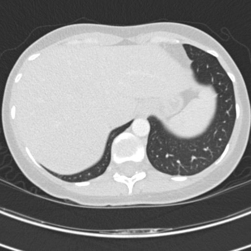 Necrobiotic pulmonary nodules - Crohn disease (Radiopaedia 20723-20631 Axial lung window 125).jpg