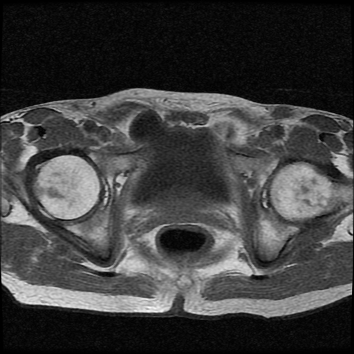 File:Necrotizing epididymo-orchitis with intra-testicular abscess (Radiopaedia 29397-29860 Axial T1 3).jpg
