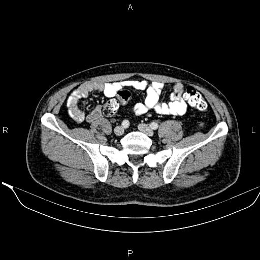 Necrotizing pancreatitis (Radiopaedia 87796-104249 A 41).jpg