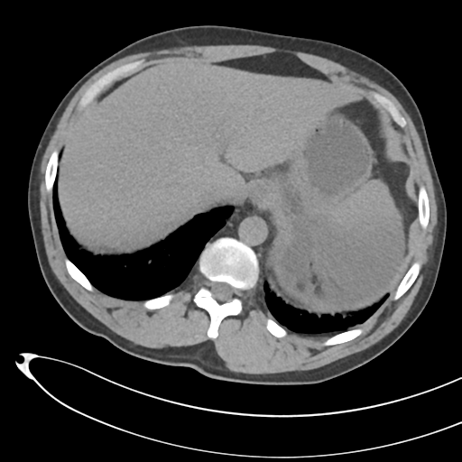 File:Necrotizing pancreatitis with acute necrotic collections (Radiopaedia 38829-41012 Axial non-contrast 16).png
