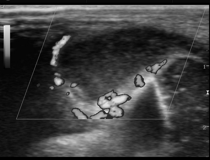 File:Neonatal knee septic arthritis (Radiopaedia 13358-13360 D 1).jpg