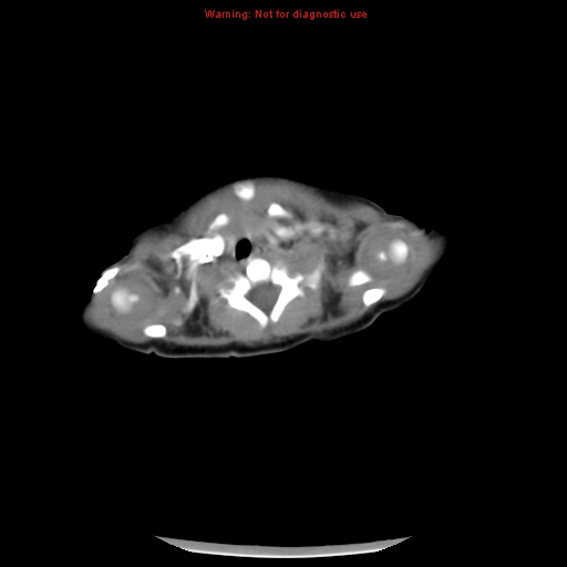 File:Neonatal neuroblastoma (Radiopaedia 9564-10223 A 2).jpg