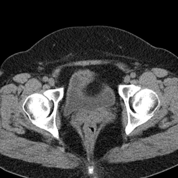 File:Nephrostomy for urosepsis (Radiopaedia 26180-26330 Axial non-contrast 65).jpg