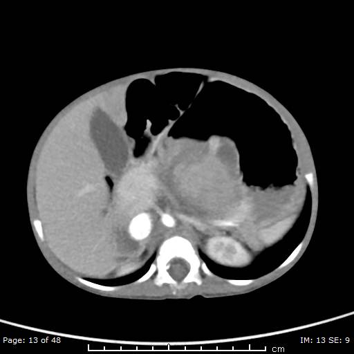 File:Neuroblastoma (Radiopaedia 41472-44355 A 13).jpg