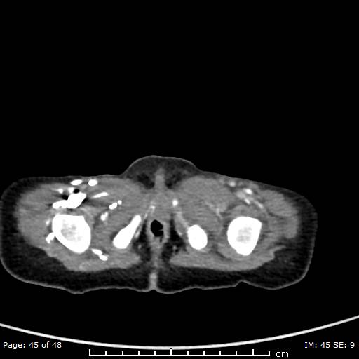 File:Neuroblastoma (Radiopaedia 41472-44355 A 45).jpg