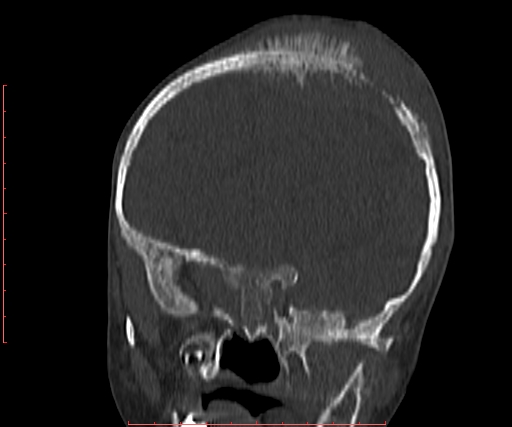 File:Neuroblastoma skull metastasis (Radiopaedia 56053-62683 Coronal bone window 14).jpg