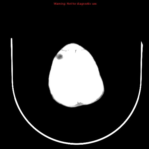 File:Neurofibromatosis type 2 (Radiopaedia 8953-9732 Axial non-contrast 30).jpg