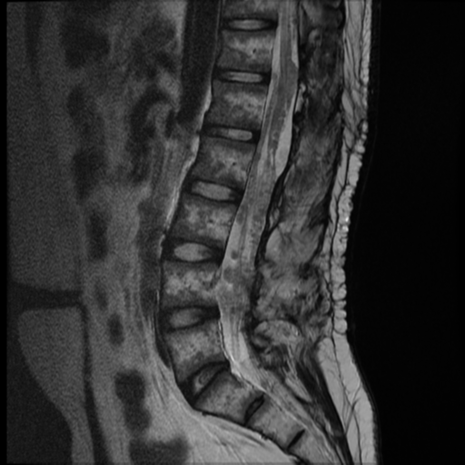 File:Neurofibromatosis type 2 (spinal manifestations) (Radiopaedia 53943-60070 E 7).png