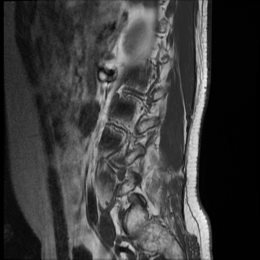 File:Neurofibromatosis type 2 (spinal manifestations) (Radiopaedia 53943-60070 F 2).png