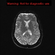 File:Neuroglial cyst (Radiopaedia 10713-11184 Axial DWI 10).jpg