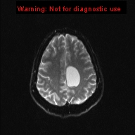 File:Neuroglial cyst (Radiopaedia 10713-11184 Axial DWI 6).jpg