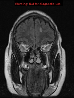 File:Neuroglial cyst (Radiopaedia 10713-11184 Coronal FLAIR 20).jpg