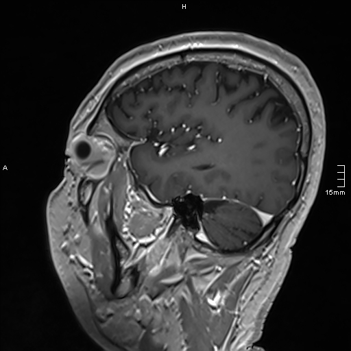 Neurosarcoidosis - involvement of the mesial temporal lobes (Radiopaedia 67429-76820 Sagittal T1 C+ 127).jpg