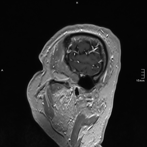 Neurosarcoidosis - involvement of the mesial temporal lobes (Radiopaedia 67429-76820 Sagittal T1 C+ 20).jpg