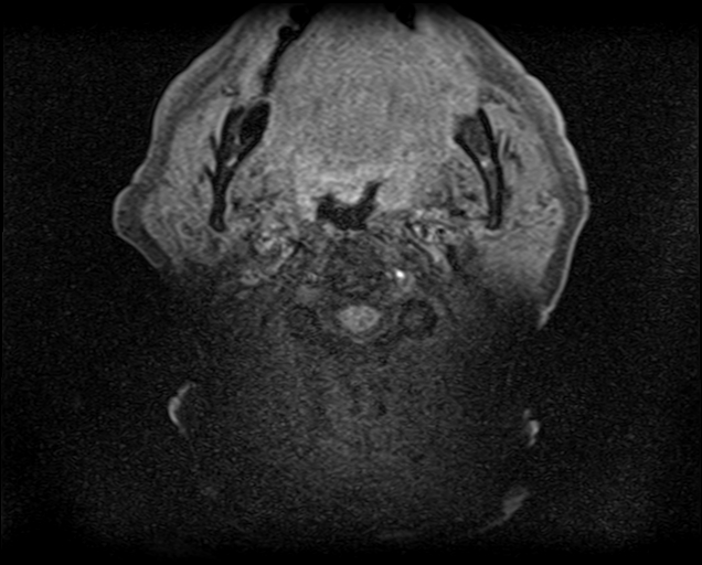 File:Non-Hodgkin lymphoma - parotid gland (Radiopaedia 71531-81890 T1 fat sat 10).jpg