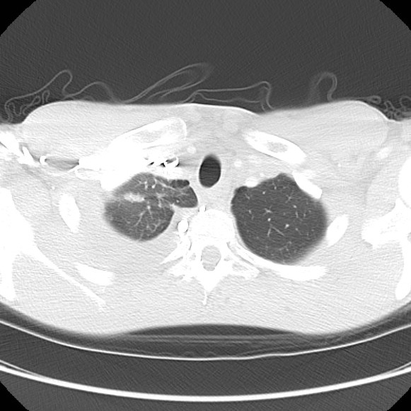 File:Non-Hodgkin lymphoma involving lung (Radiopaedia 29094-29470 Axial lung window 13).jpg