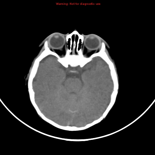 File:Non-accidental injury - bilateral subdural with acute blood (Radiopaedia 10236-10765 Axial non-contrast 7).jpg