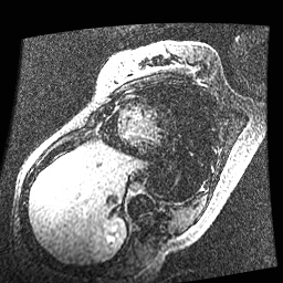 File:Non-compaction of the left ventricle (Radiopaedia 38868-41062 E 6).jpg