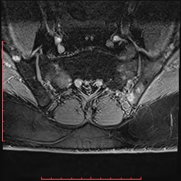 Non Hodgkin's lymphoma with metastasis to spine (Radiopaedia 54844-61103 Axial T1 C+ fat sat 23).jpg