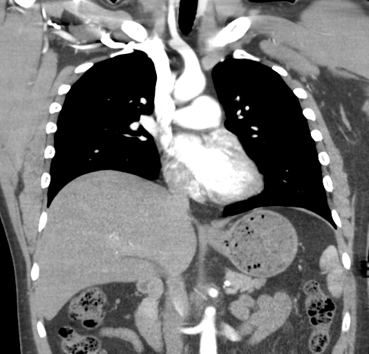 File:Normal CTA thorax (non ECG gated) (Radiopaedia 41750-44704 B 44).png