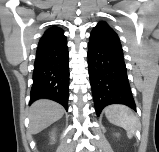 File:Normal CTA thorax (non ECG gated) (Radiopaedia 41750-44704 B 67).png