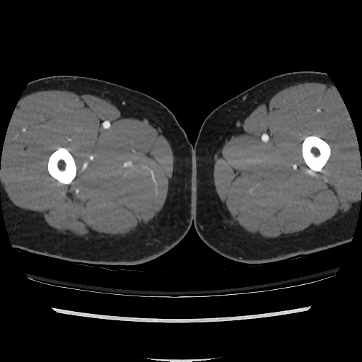 File:Normal CT angiogram of pelvis (Radiopaedia 45390-49430 A 78).jpg