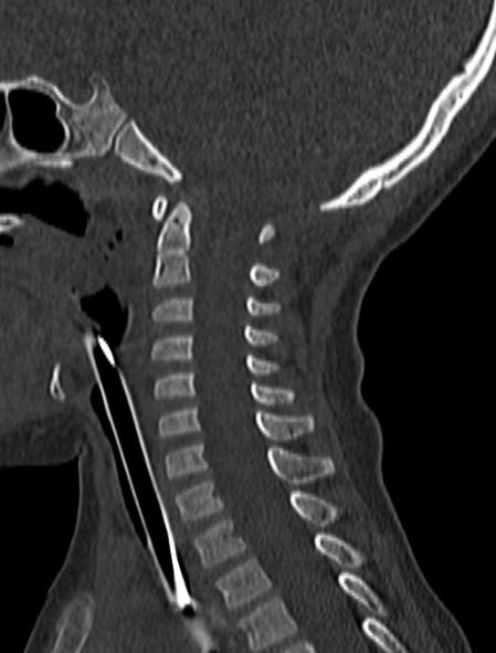 Normal CT cervical spine - pediatric (Radiopaedia 52549-58462 Sagittal bone window 102).jpg