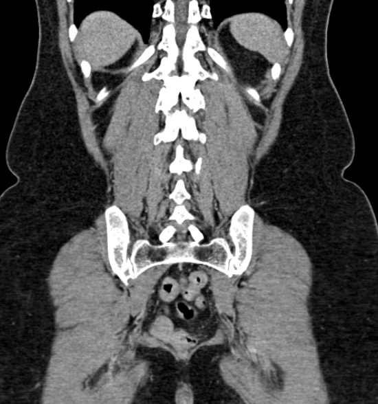 Normal CT intravenous urogram (Radiopaedia 39444-41759 A 350).jpg