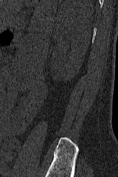 File:Normal CT lumbar spine (Radiopaedia 53981-60118 Sagittal bone window 96).jpg