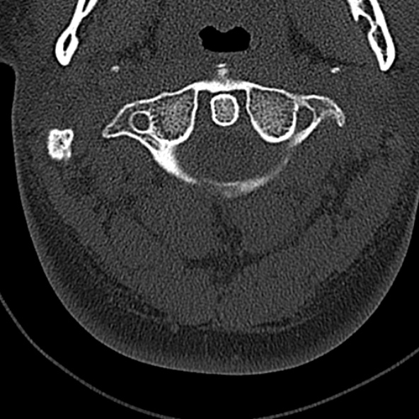 Normal CT of the cervical spine (Radiopaedia 53322-59305 Axial bone window 63).jpg