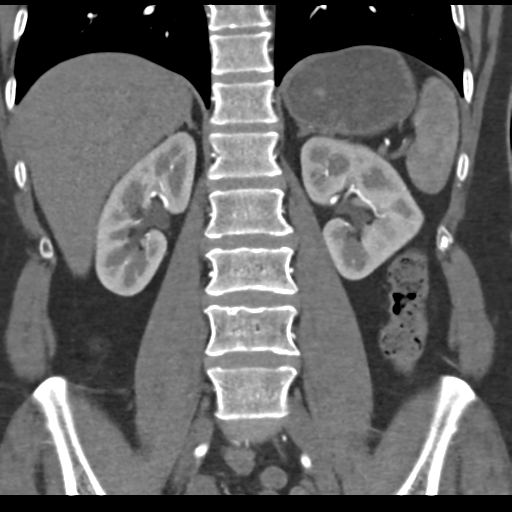 File:Normal CT renal artery angiogram (Radiopaedia 38727-40889 B 49).png