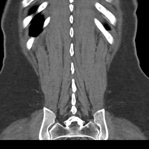 File:Normal CT renal artery angiogram (Radiopaedia 38727-40889 B 66).png