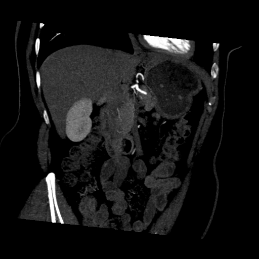 File:Normal CT renal artery angiogram (Radiopaedia 38727-40889 D 7).png