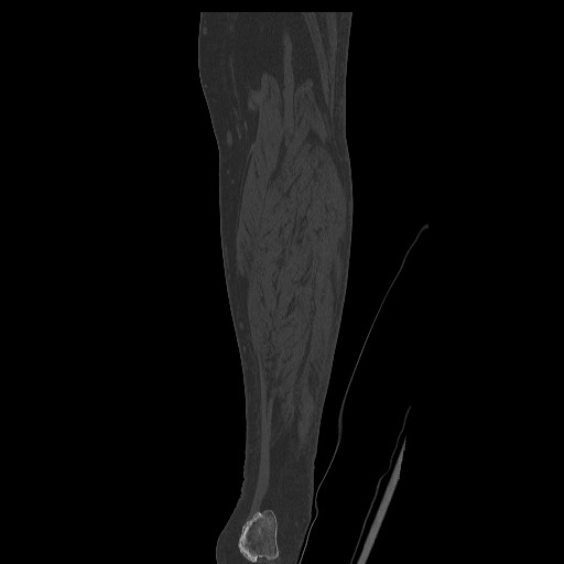 Normal CT tibia and fibula (Radiopaedia 51195-56848 Coronal non-contrast 53).jpg