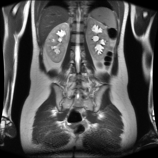 File:Normal MRI abdomen in pregnancy (Radiopaedia 88001-104541 Coronal T2 24).jpg