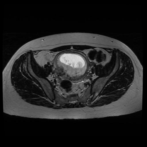 Normal MRI abdomen in pregnancy (Radiopaedia 88005-104548 Axial T2 25).jpg