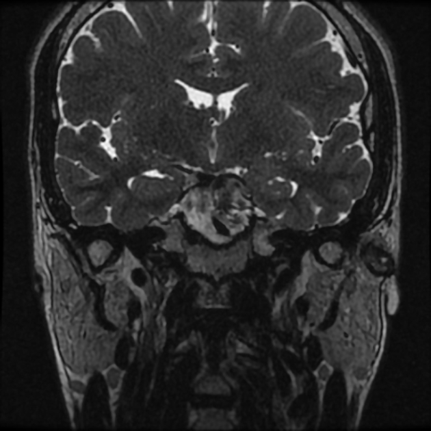 Normal MRI petrous (Radiopaedia 91317-108949 Coronal T2 24).jpg