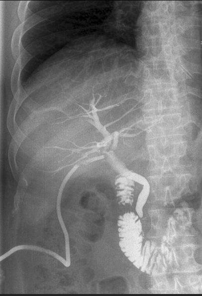File:Normal T-tube cholangiography (Radiopaedia 67244-76601 B 1).PNG