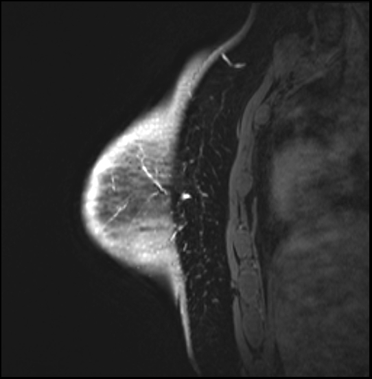 Normal breast MRI - dense breasts (Radiopaedia 80454-93850 I 149).jpg