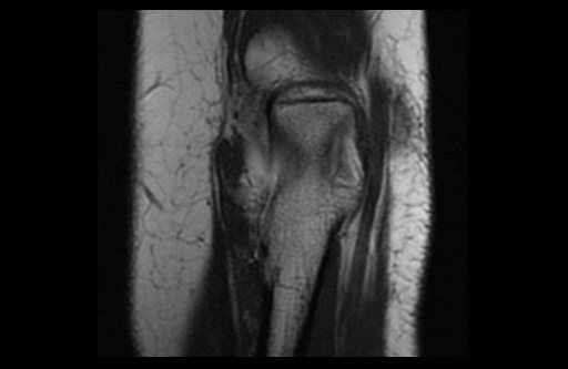 File:Normal elbow arthrograms (Radiopaedia 75550-86805 Coronal T1 5).jpg