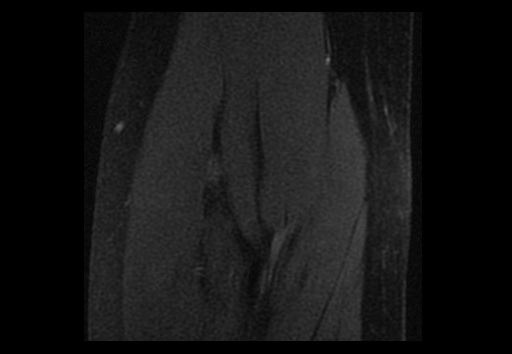 File:Normal elbow arthrograms (Radiopaedia 75550-86805 Coronal T1 fat sat 12).jpg