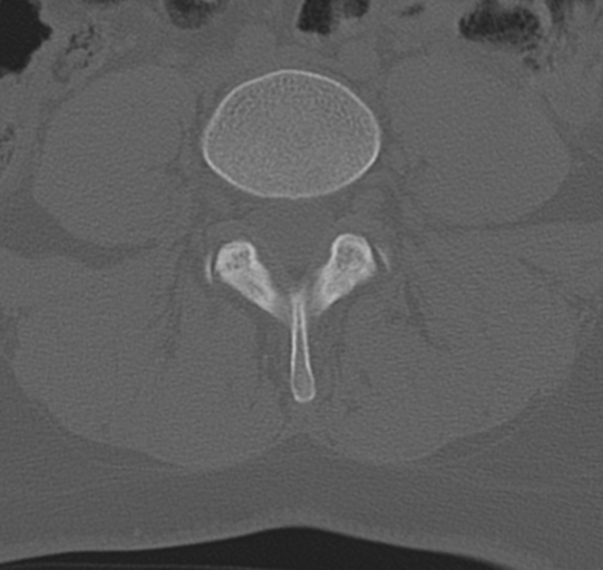 File:Normal lumbar spine CT (Radiopaedia 46533-50986 Axial bone window 51).png