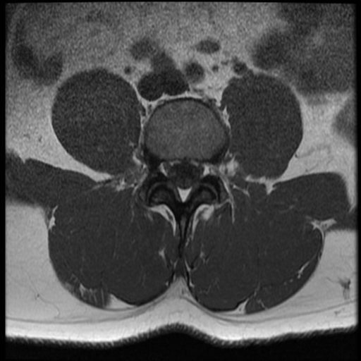 File:Normal lumbar spine MRI (Radiopaedia 35543-37039 Axial T1 19).png
