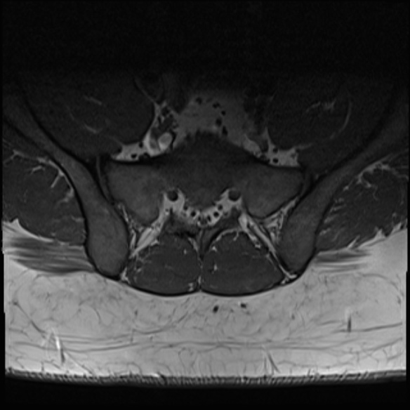 File:Normal lumbar spine MRI (Radiopaedia 47857-52609 Axial T1 33).jpg