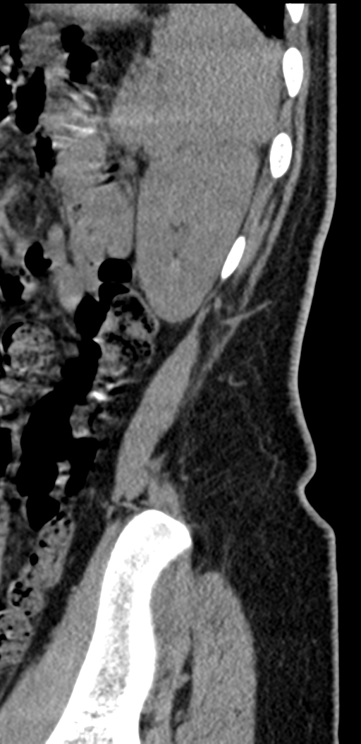 Normal lumbosacral CT (Radiopaedia 37923-39867 E 10).png