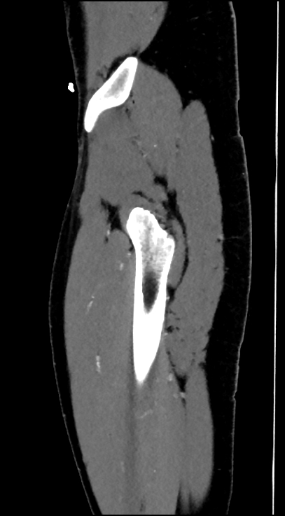 Normal pelvis CT angiogram (Radiopaedia 84966-100481 C 13).jpg