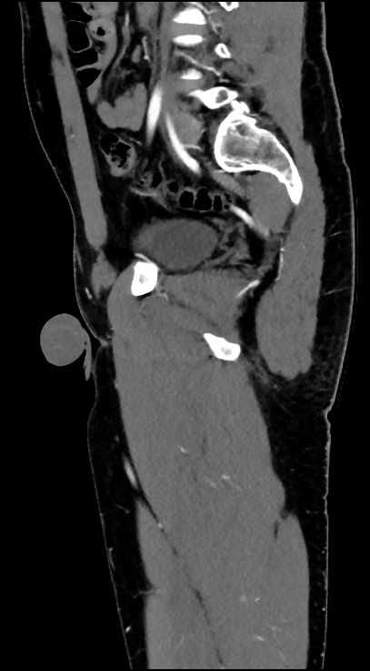 Normal pelvis CT angiogram (Radiopaedia 84966-100481 C 67).jpg