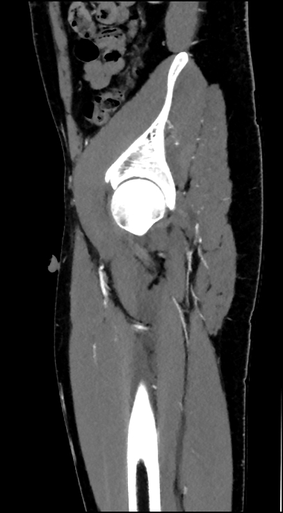 Normal pelvis CT angiogram (Radiopaedia 84966-100481 C 83).jpg