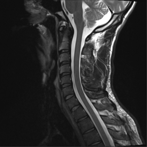 File:Normal trauma cervical spine (Radiopaedia 41017-43762 Sagittal T2 8).png