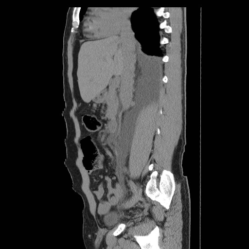File:Obstructed kidney with perinephric urinoma (Radiopaedia 26889-27066 B 23).jpg